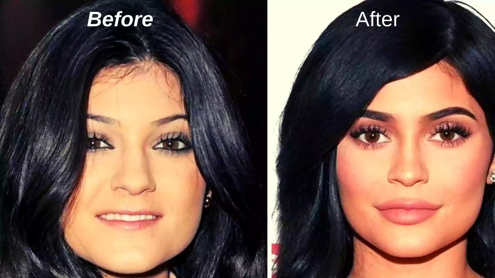 Kylie Jenner Pre Surgery